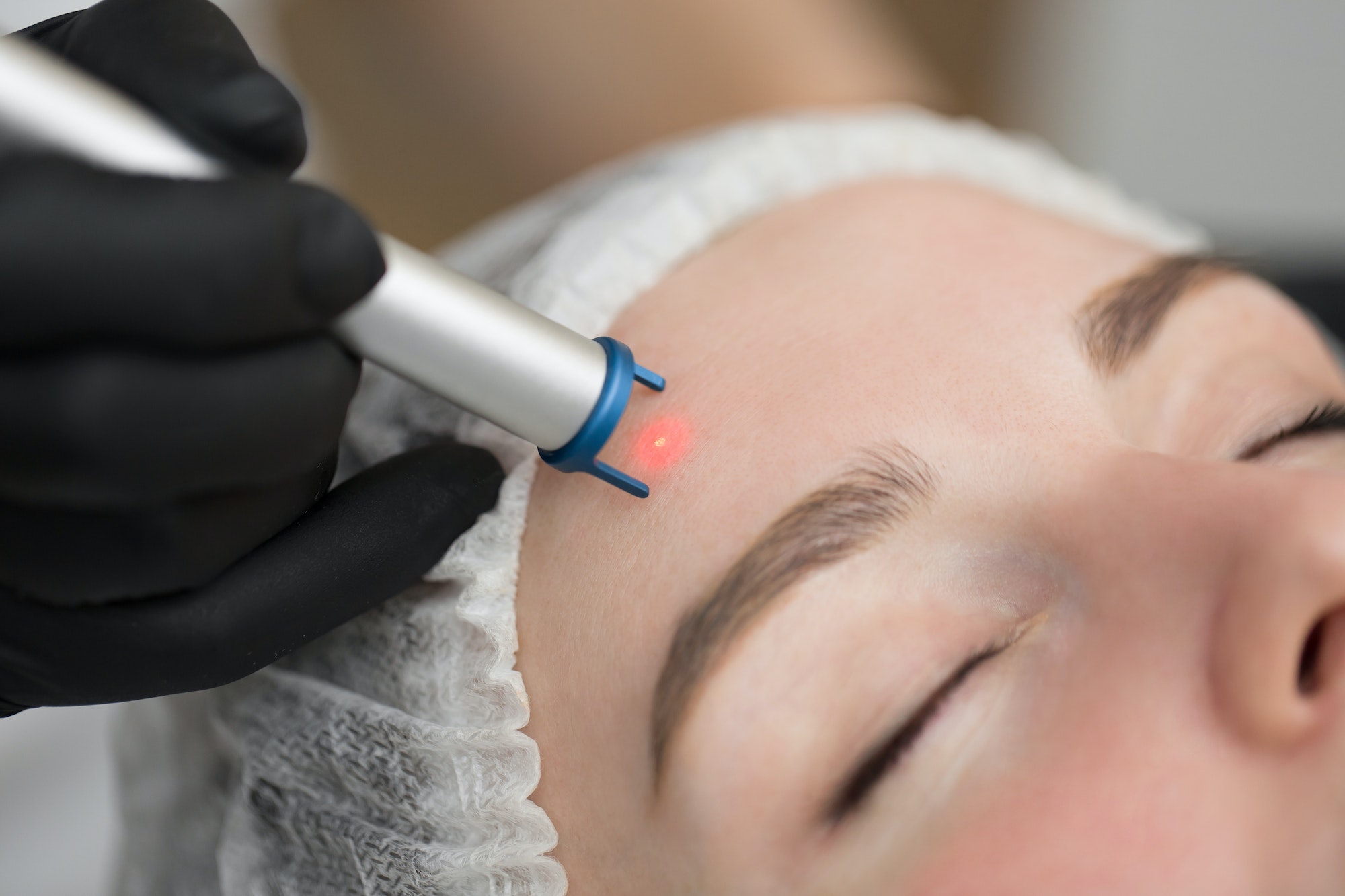 Close-up removal of blood vessels on the face of a diode laser in a cosmetic clinic. Therapist