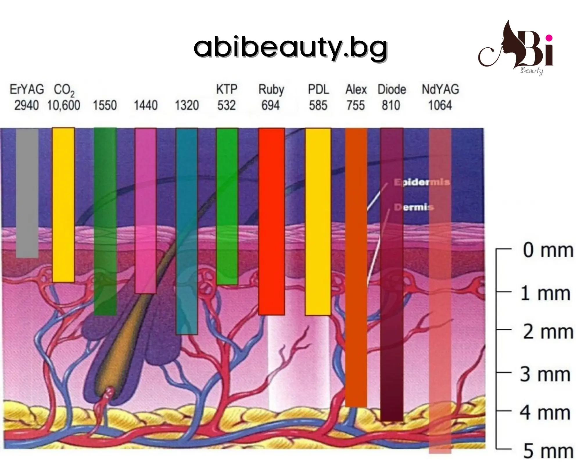 Сравнение на три вида лазера за епилация — диоден 810 nm, александритен 755 nm и Nd:YAG 1064 nm
