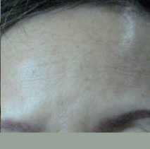 HIFU Ultraformer III forehead wrinkles treatment - after