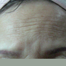 HIFU Ultraformer III forehead wrinkles treatment - before
