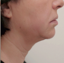 HIFU Ultraformer III double chin treatment - after