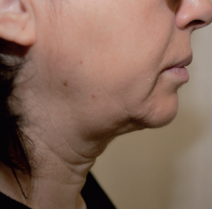 HIFU Ultraformer III double chin treatment - before