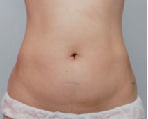 HIFU Ultraformer III belly treatment - after