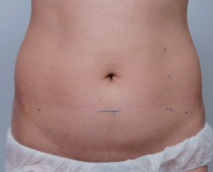 HIFU Ultraformer III belly treatment - before