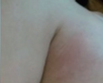 HIFU Ultraformer III armpit treatment - after