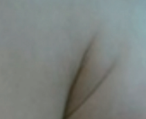 HIFU Ultraformer III armpit treatment - before