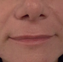 HIFU Ultraformer III nasolabial folds treatment - after