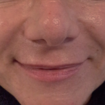 HIFU Ultraformer III nasolabial folds treatment - before